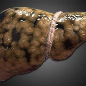 「肝癌」一發現就是晚期？你若出現這些症狀，就千萬要注意！ ...